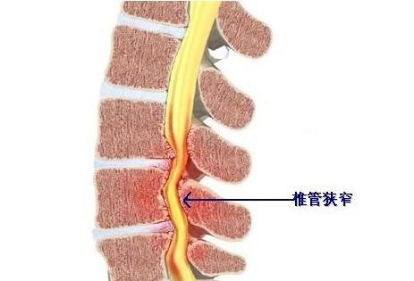 腰椎病治疗不及时的危害有哪些