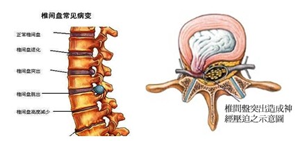 颈椎间盘突出