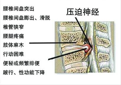 腰椎间盘突出症的检查方法