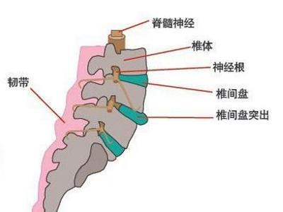 腰椎间盘突出症的危害