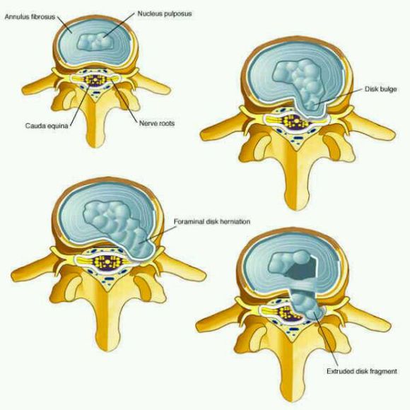 腰椎间盘突出的危害有多大