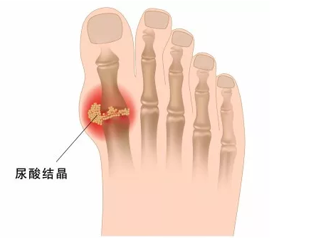 福州骨科医院治疗痛风