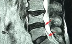 福州治疗腰椎间盘突出腿痛腿麻去哪家医院好